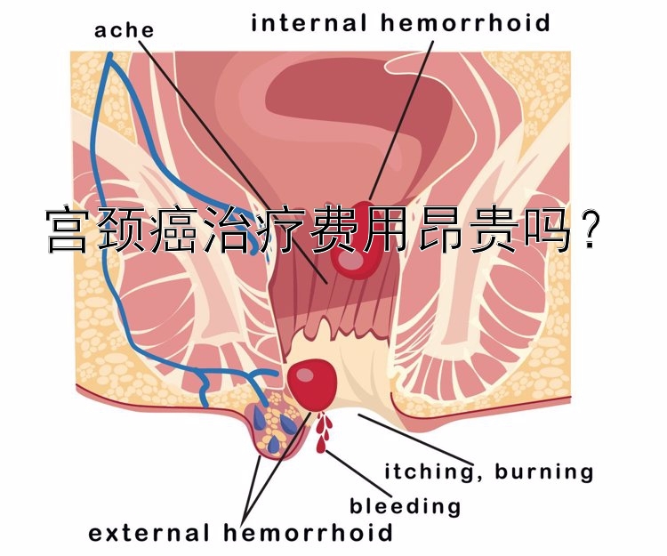 宫颈癌治疗费用昂贵吗？