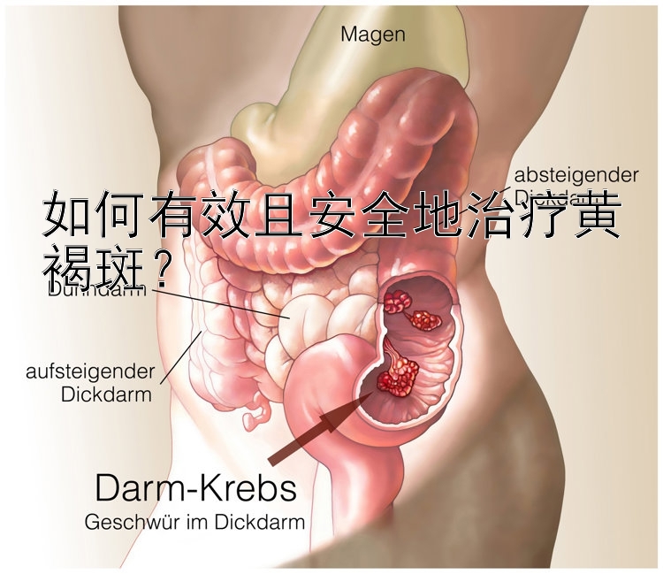 如何有效且安全地治疗黄褐斑？