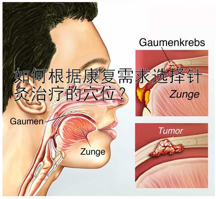 如何根据康复需求选择针灸治疗的穴位？