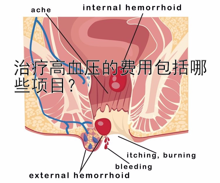 治疗高血压的费用包括哪些项目？