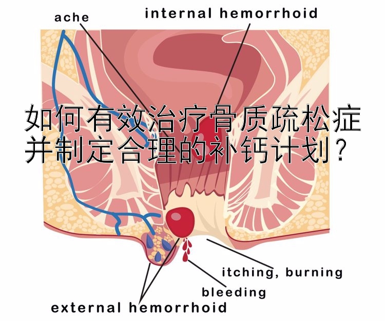 如何有效治疗骨质疏松症并制定合理的补钙计划？