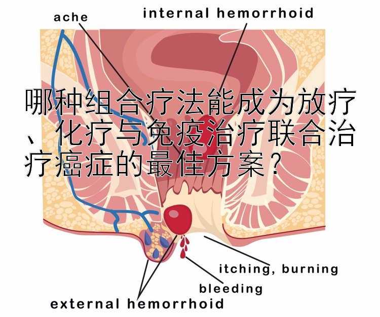 哪种组合疗法能成为放疗、化疗与免疫治疗联合治疗癌症的最佳方案？