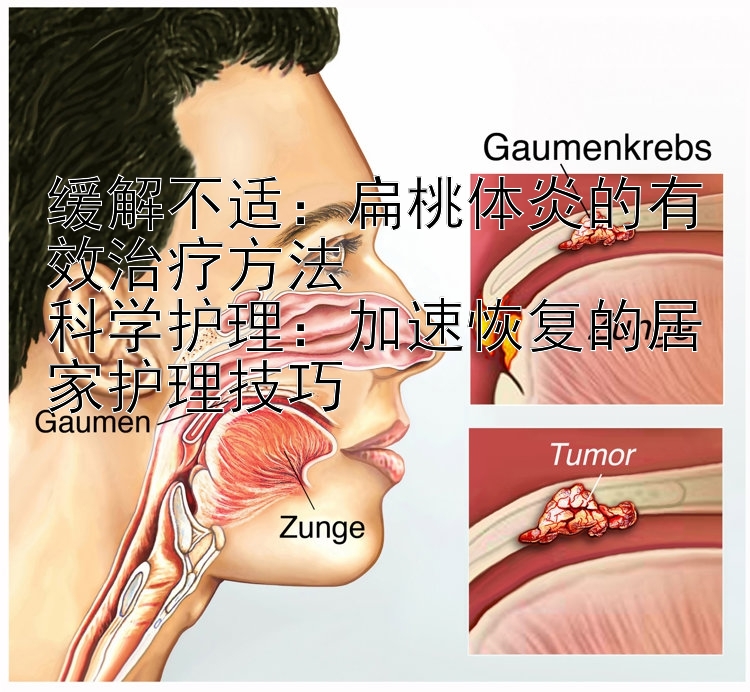 缓解不适：扁桃体炎的有效治疗方法  