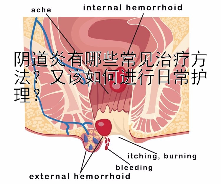 阴道炎有哪些常见治疗方法？又该如何进行日常护理？