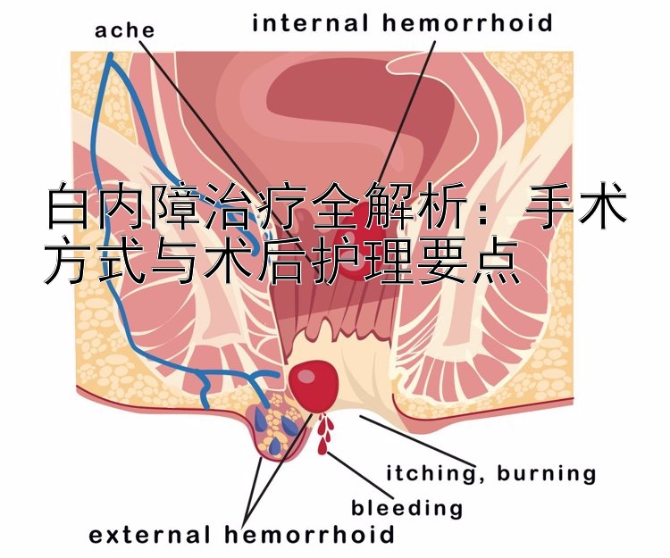 白内障治疗全解析：手术方式与术后护理要点