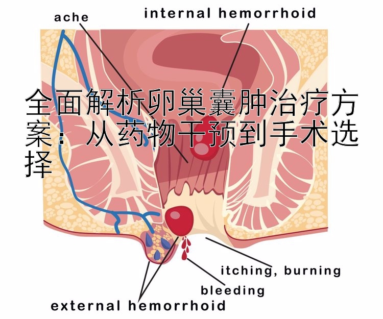 全面解析卵巢囊肿治疗方案：从药物干预到手术选择