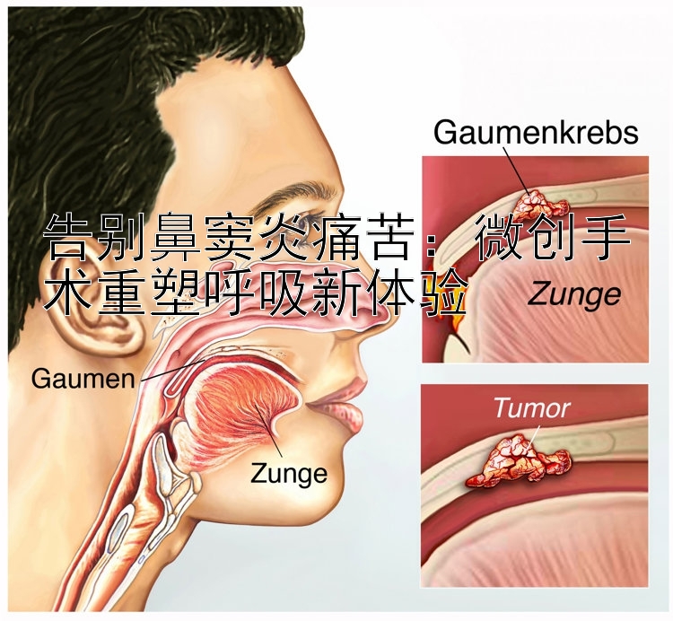 告别鼻窦炎痛苦：微创手术重塑呼吸新体验