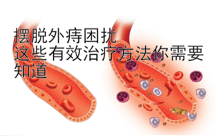 摆脱外痔困扰  
这些有效治疗方法你需要知道