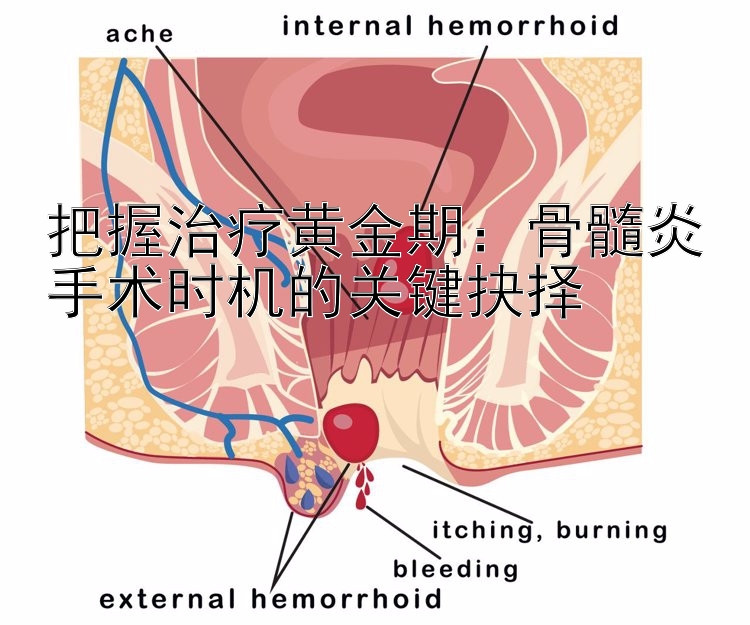 把握治疗黄金期：骨髓炎手术时机的关键抉择