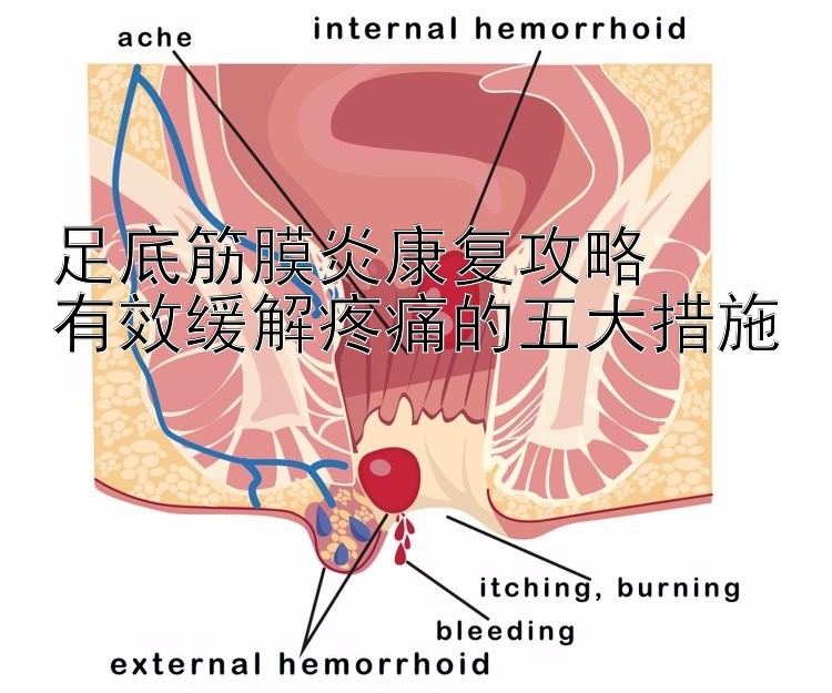 足底筋膜炎康复攻略  
有效缓解疼痛的五大措施